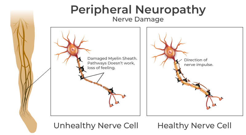 Peripheral Neuropathy